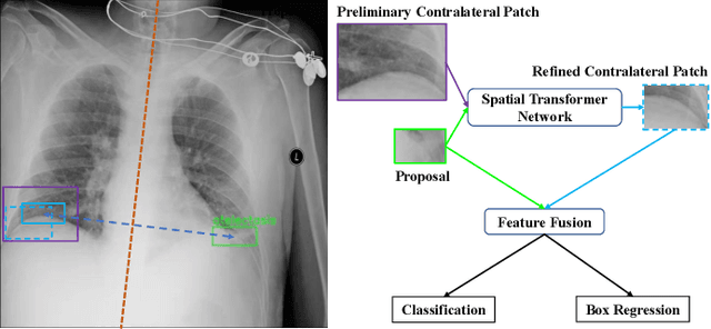 Figure 1 for Contralaterally Enhanced Networks for Thoracic Disease Detection