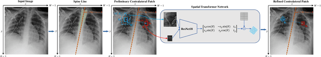 Figure 2 for Contralaterally Enhanced Networks for Thoracic Disease Detection