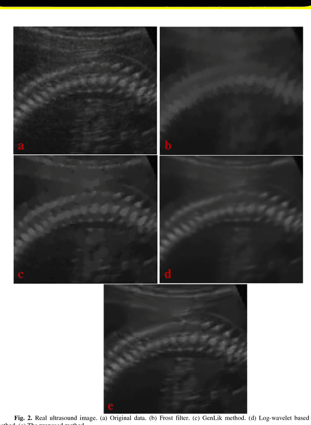 Figure 1 for A new ultrasound despeckling method through adaptive threshold