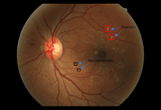 Figure 1 for DRDrV3: Complete Lesion Detection in Fundus Images Using Mask R-CNN, Transfer Learning, and LSTM