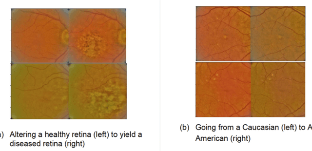 Figure 1 for Addressing Artificial Intelligence Bias in Retinal Disease Diagnostics