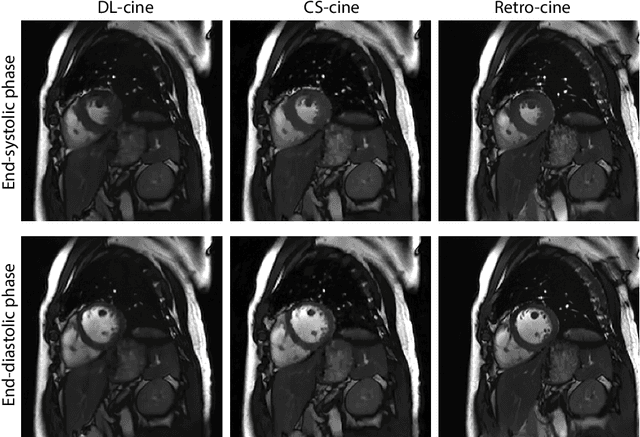 Figure 1 for Cardiac Functional Analysis with Cine MRI via Deep Learning Reconstruction
