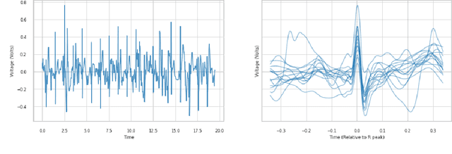 Figure 1 for Representing and Denoising Wearable ECG Recordings