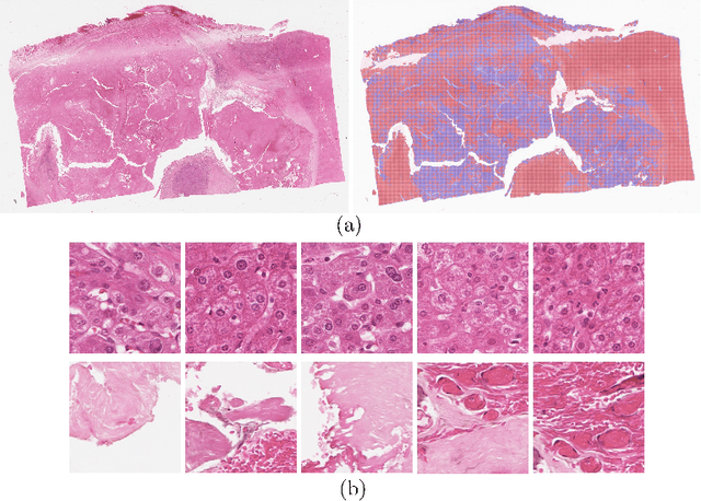 Figure 3 for Multi-Scale Attention-based Multiple Instance Learning for Classification of Multi-Gigapixel Histology Images