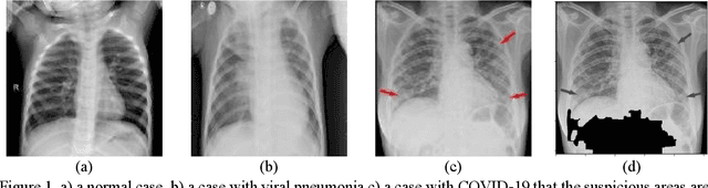 Figure 1 for Improving performance of CNN to predict likelihood of COVID-19 using chest X-ray images with preprocessing algorithms