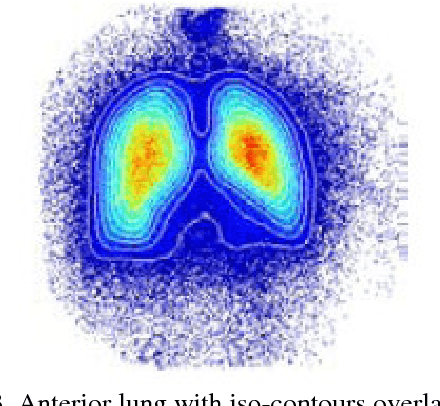 Figure 3 for Automatic Detection of Pulmonary Embolism using Computational Intelligence