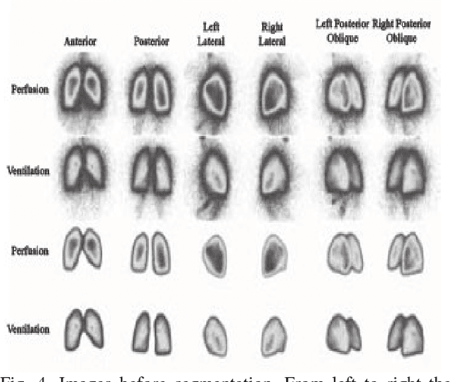 Figure 4 for Automatic Detection of Pulmonary Embolism using Computational Intelligence