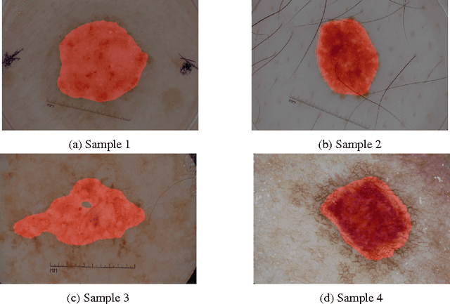 Figure 3 for LesionSeg: Semantic segmentation of skin lesions using Deep Convolutional Neural Network
