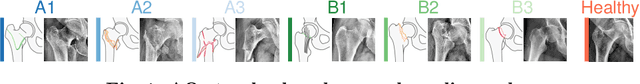 Figure 1 for Medical-based Deep Curriculum Learning for Improved Fracture Classification