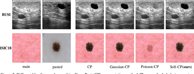 Figure 1 for Soft-CP: A Credible and Effective Data Augmentation for Semantic Segmentation of Medical Lesions