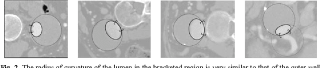 Figure 3 for Aorta Segmentation for Stent Simulation