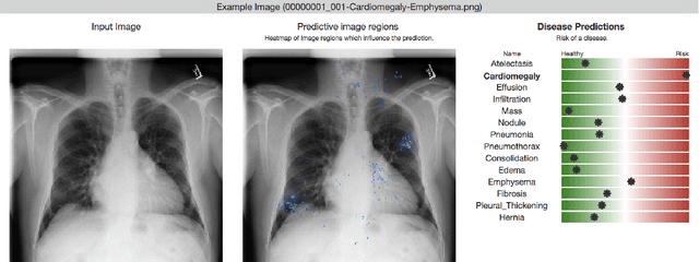 Figure 1 for Chester: A Web Delivered Locally Computed Chest X-Ray Disease Prediction System