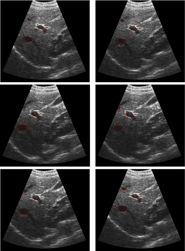 Figure 4 for Tumor Motion Tracking in Liver Ultrasound Images Using Mean Shift and Active Contour