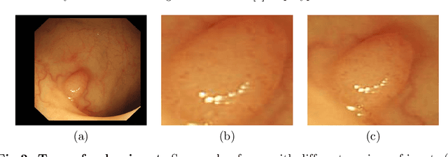 Figure 3 for A Comparative Study on Polyp Classification using Convolutional Neural Networks