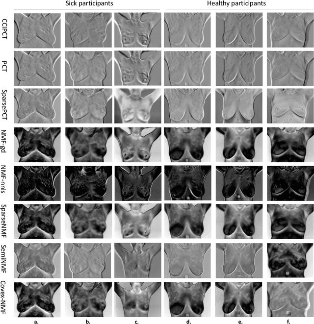 Figure 4 for Low-rank Convex/Sparse Thermal Matrix Approximation for Infrared-based Diagnostic System