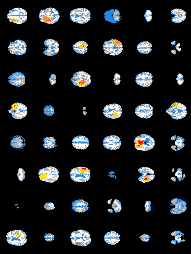 Figure 4 for Synthesizing brain tumor images and annotations by combining progressive growing GAN and SPADE