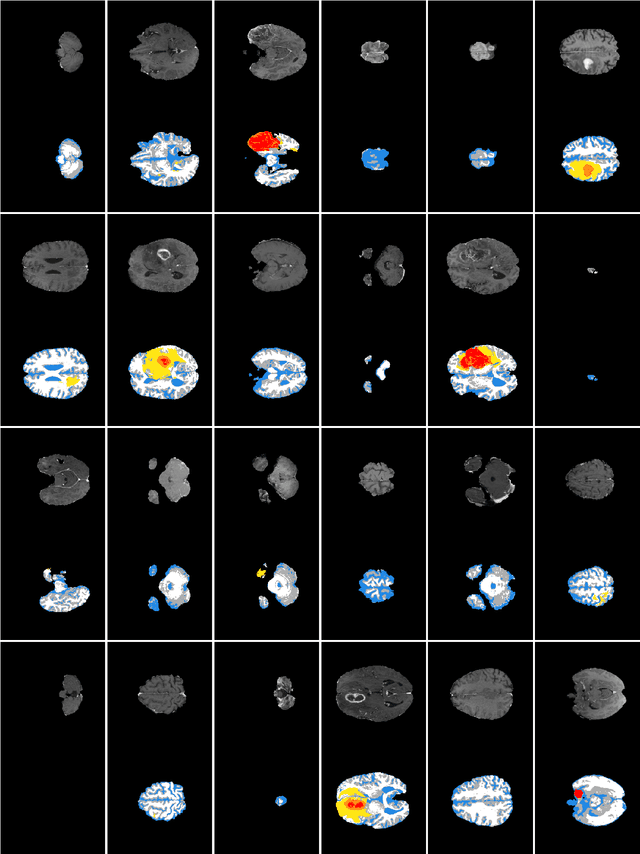 Figure 2 for Synthesizing brain tumor images and annotations by combining progressive growing GAN and SPADE