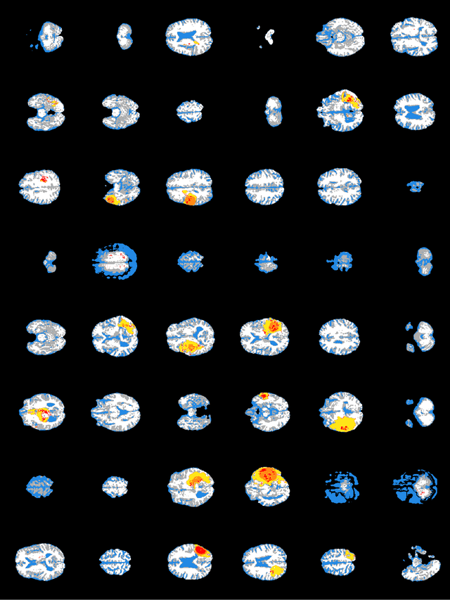 Figure 3 for Synthesizing brain tumor images and annotations by combining progressive growing GAN and SPADE