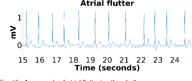 Figure 2 for Piece-wise Matching Layer in Representation Learning for ECG Classification