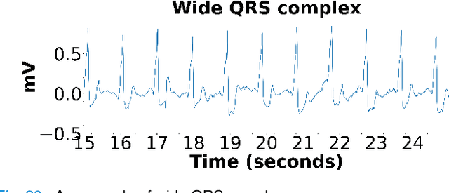 Figure 4 for Piece-wise Matching Layer in Representation Learning for ECG Classification