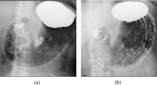 Figure 3 for Self-Supervised Learning for Gastritis Detection with Gastric X-Ray Images