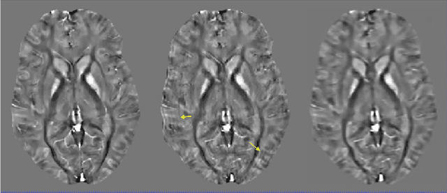 Figure 3 for Motion Artifact Reduction in Quantitative Susceptibility Mapping using Deep Neural Network