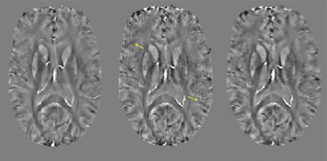 Figure 4 for Motion Artifact Reduction in Quantitative Susceptibility Mapping using Deep Neural Network