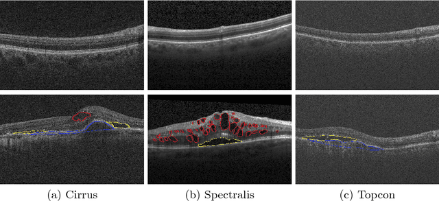 Figure 1 for Retinal Fluid Segmentation and Detection in Optical Coherence Tomography Images using Fully Convolutional Neural Network