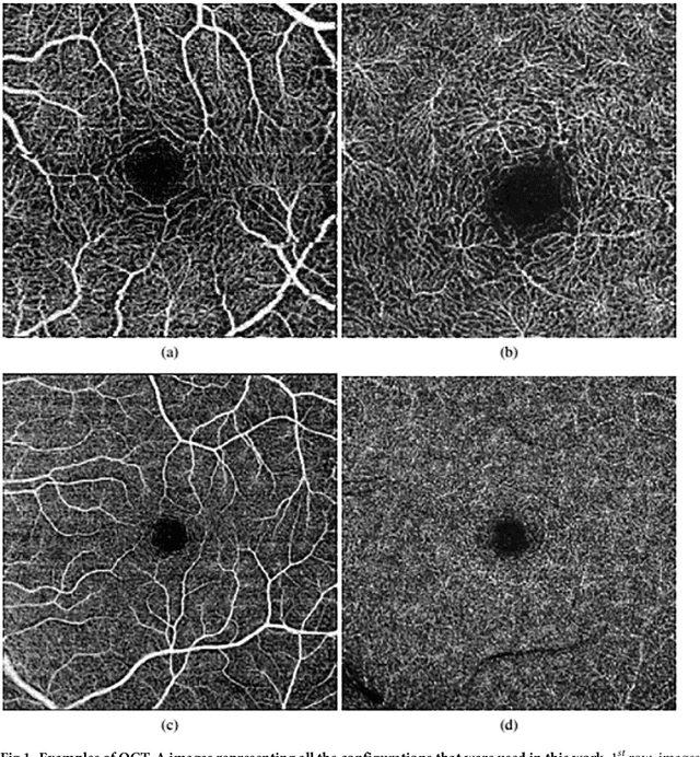 Figure 1 for Automatic segmentation of the Foveal Avascular Zone in ophthalmological OCT-A images