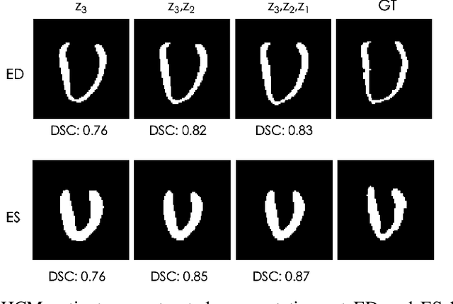 Figure 3 for Explainable Shape Analysis through Deep Hierarchical Generative Models: Application to Cardiac Remodeling