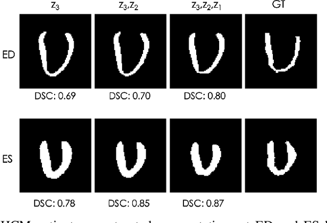 Figure 4 for Explainable Shape Analysis through Deep Hierarchical Generative Models: Application to Cardiac Remodeling