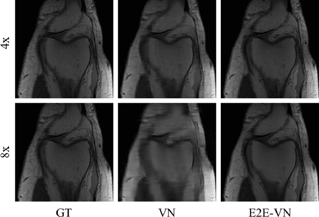 Figure 3 for End-to-End Variational Networks for Accelerated MRI Reconstruction