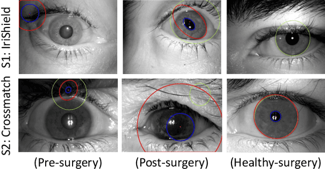 Figure 1 for SegDenseNet: Iris Segmentation for Pre and Post Cataract Surgery