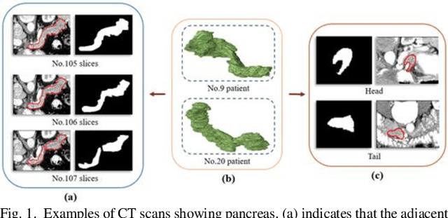 Figure 1 for Probability Map Guided Bi-directional Recurrent UNet for Pancreas Segmentation