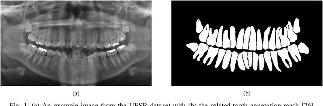 Figure 1 for PaXNet: Dental Caries Detection in Panoramic X-ray using Ensemble Transfer Learning and Capsule Classifier