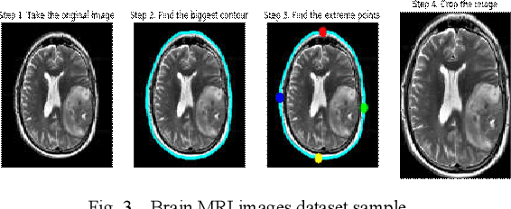 Figure 3 for Deep Convolutional Neural Networks Model-based Brain Tumor Detection in Brain MRI Images