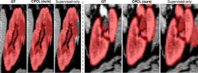 Figure 4 for All-Around Real Label Supervision: Cyclic Prototype Consistency Learning for Semi-supervised Medical Image Segmentation
