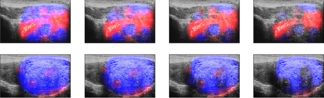 Figure 4 for Towards Confident Detection of Prostate Cancer using High Resolution Micro-ultrasound