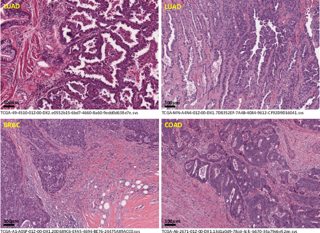 Figure 1 for WSSS4LUAD: Grand Challenge on Weakly-supervised Tissue Semantic Segmentation for Lung Adenocarcinoma