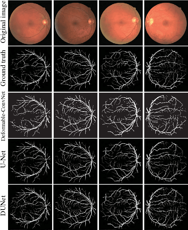 Figure 3 for DUNet: A deformable network for retinal vessel segmentation