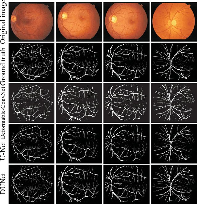 Figure 4 for DUNet: A deformable network for retinal vessel segmentation