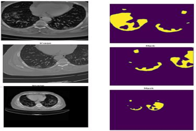 Figure 1 for AI-Powered Semantic Segmentation and Fluid Volume Calculation of Lung CT images in Covid-19 Patients