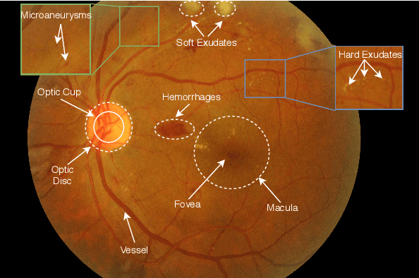 Figure 1 for Applications of Deep Learning in Fundus Images: A Review