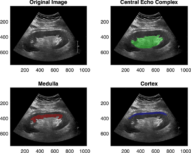 Figure 3 for The Kidneys Are Not All Normal: Investigating the Speckle Distributions of Transplanted Kidneys