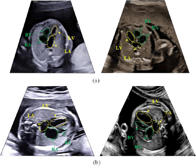 Figure 1 for Automatic Detection of Cardiac Chambers Using an Attention-based YOLOv4 Framework from Four-chamber View of Fetal Echocardiography