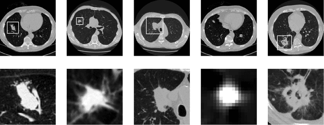 Figure 1 for Evaluate the Malignancy of Pulmonary Nodules Using the 3D Deep Leaky Noisy-or Network
