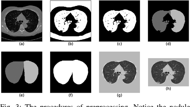 Figure 3 for Evaluate the Malignancy of Pulmonary Nodules Using the 3D Deep Leaky Noisy-or Network