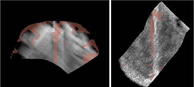 Figure 2 for Fully Automatic Segmentation of 3D Brain Ultrasound: Learning from Coarse Annotations