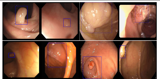 Figure 1 for Y-Net: A deep Convolutional Neural Network for Polyp Detection