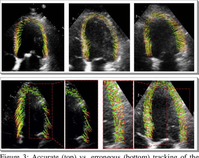 Figure 4 for Left Ventricular Wall Motion Estimation by Active Polynomials for Acute Myocardial Infarction Detection